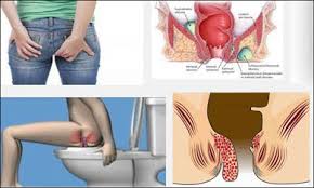 Obat Sakit Wasir Herbal