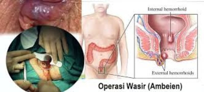 Ambeclear De Nature Kaskus