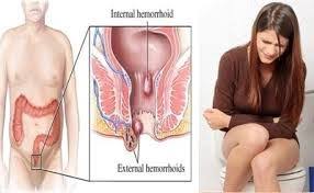 Milo Penyebab Sembelit